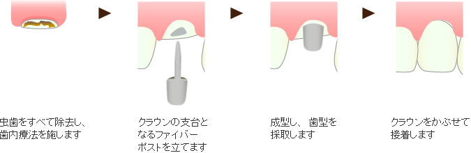 クラウン修復法の治療イメージ