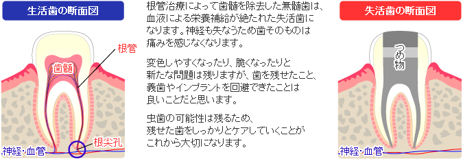 失活歯と生活歯の違い