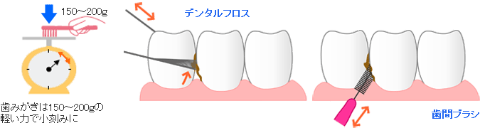 ＴＢＩ（歯磨き指導）