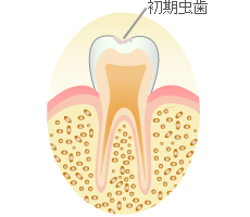 初期の虫歯