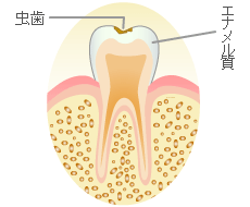 エナメル質の虫歯