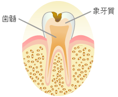 象牙質の虫歯