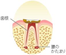 歯冠崩壊した末期の虫歯