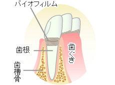 歯肉炎