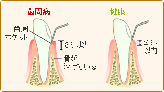 歯周ポケット深度測定