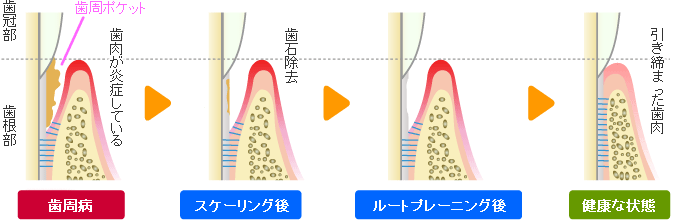 ルートプレーニング（歯根面クリーニング）