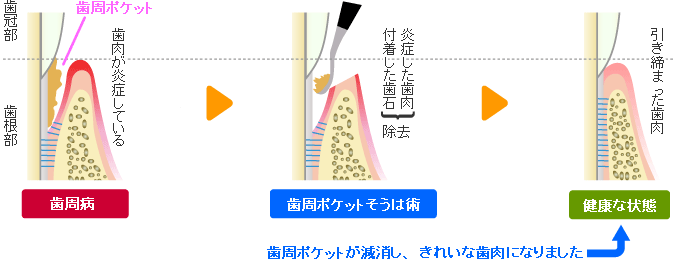 歯周ポケット掻爬(そうは)術