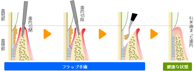 フラップ手術（歯肉剥離掻爬手術）