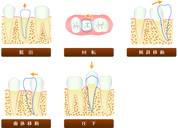 ＭＴＭ矯正の種類