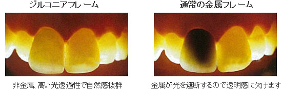 ジルコニアフレームと金属フレームの比較