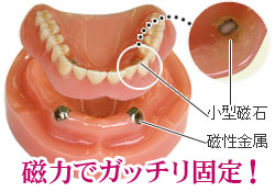 マグネットアタッチメント義歯