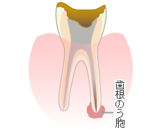 歯根のう胞摘出術