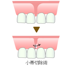 小帯切除術