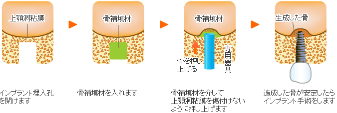 ソケットリフト法