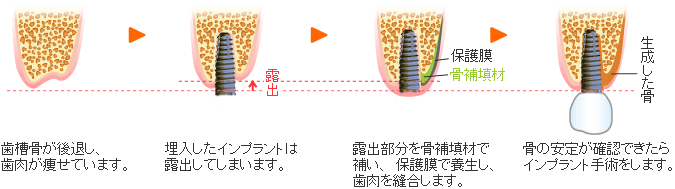 骨誘導再生療法（GBR法）