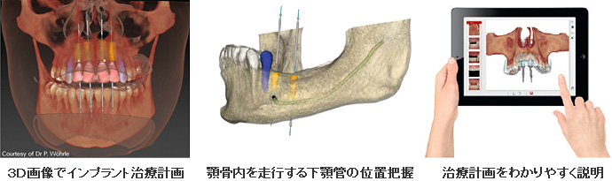 ３Ｄ画像でインプラント治療計画