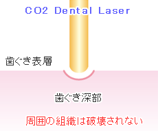 歯科レーザー治療