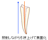 根管治療