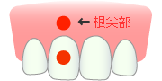 知覚過敏の解消