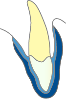 スポーツマウスガード：Ｍｅｄｉｕｍ