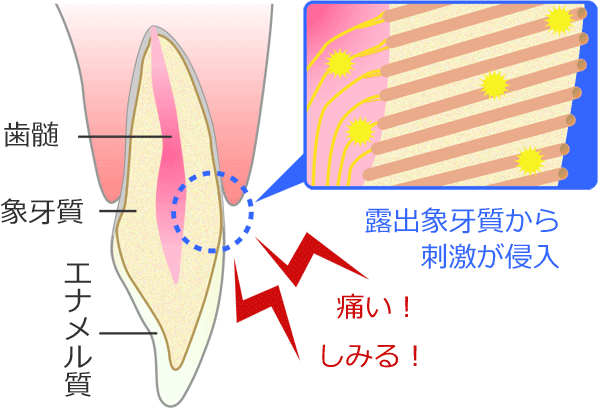 知覚過敏の解消