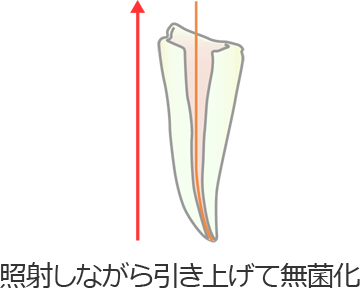 根管治療