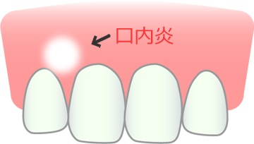 口内炎の改善