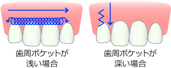 歯周病の治癒促進
