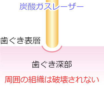 歯科レーザーによる治療イメージ